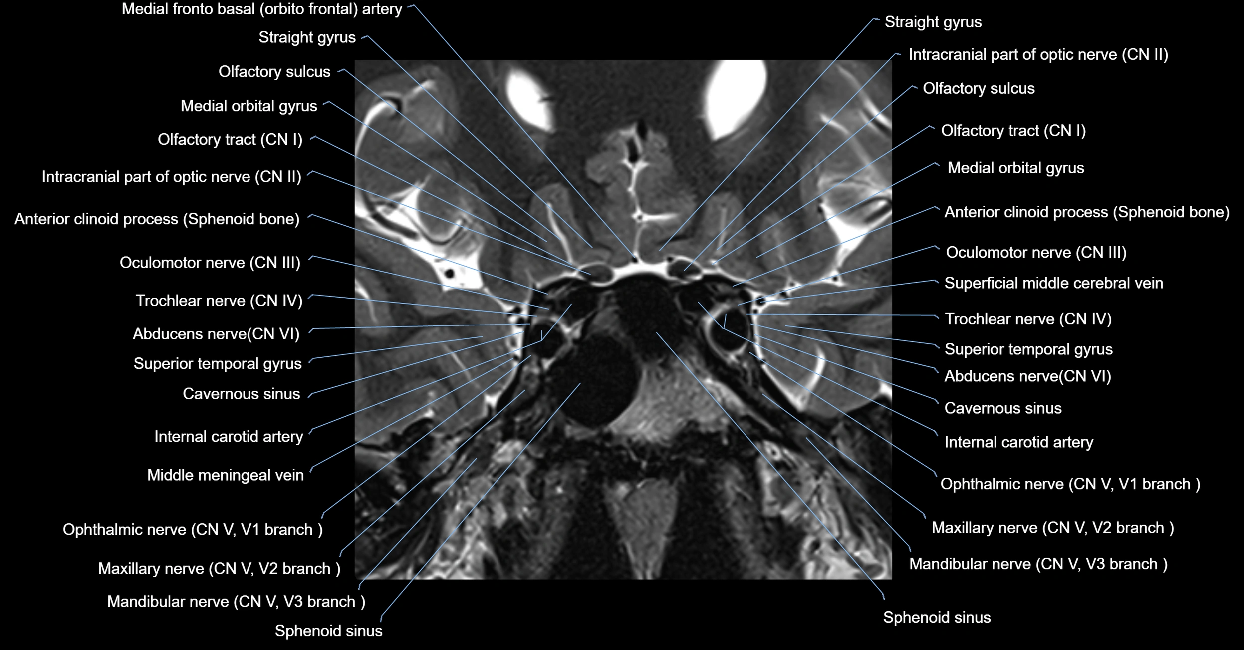 MRI cavernous sinus coronal cross sectional 3T anatomy image-img-00001-00007.webp